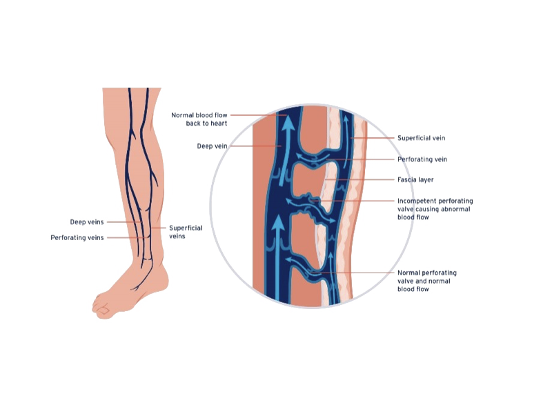 Diagram of leg veins showing superficial, deep, and perforating veins. A close-up highlights blood flow through the veins and valves. Diagram of leg veins showing superficial, deep, and perforating veins. A close-up highlights blood flow through the veins and valves.